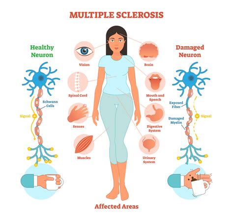 complete list of ms symptoms.